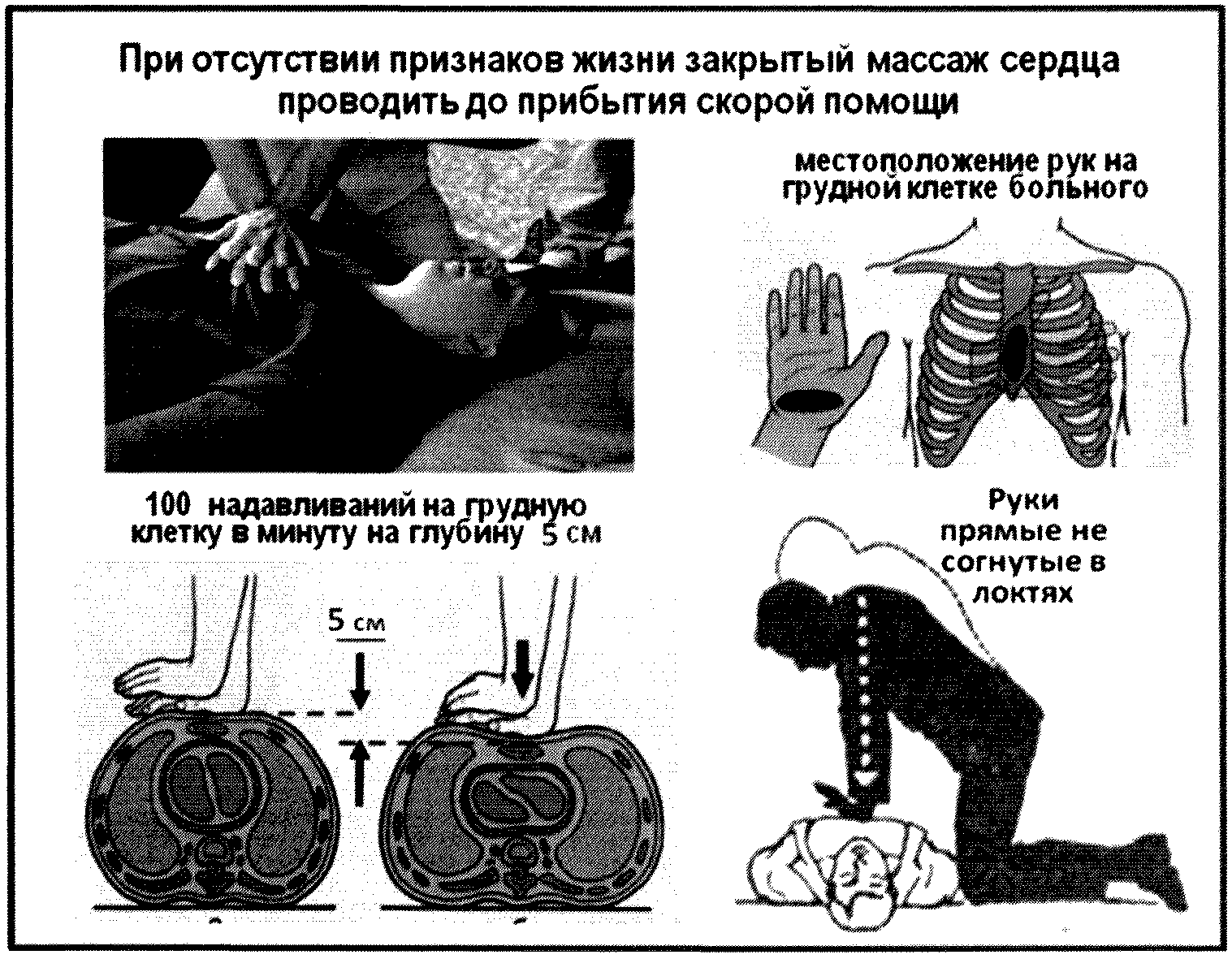 Прямой массаж сердца картинки