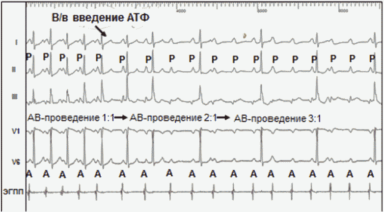 Тахикардии с широкими комплексами QRS (дифференциальный диагноз, лечебная тактика)