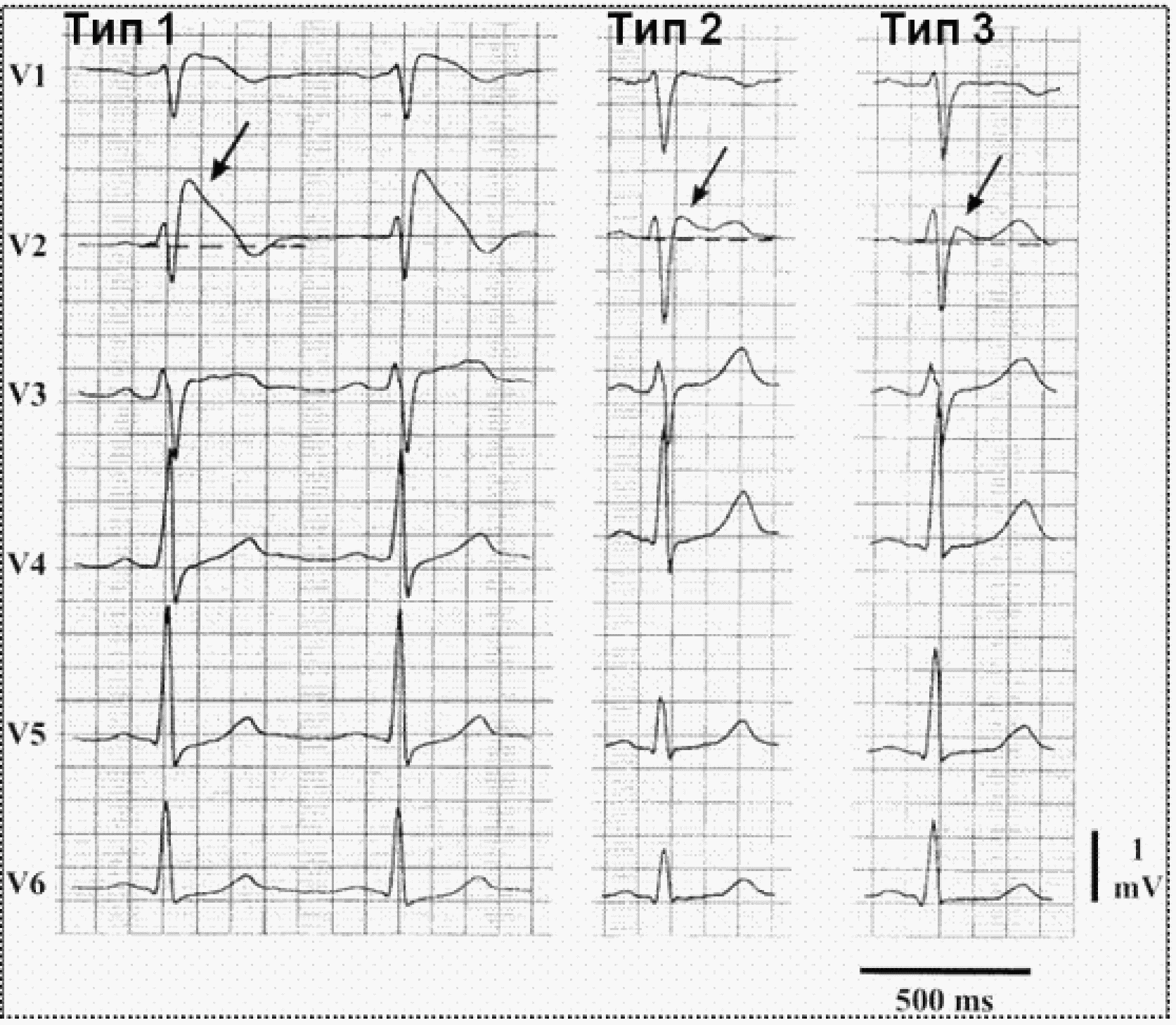 Типы экг. Синдром Бругада Тип 2 ЭКГ. Эпсилон волна в отведении v1. См Бругада на ЭКГ 2 Тип. Синдром Бругада на ЭКГ.