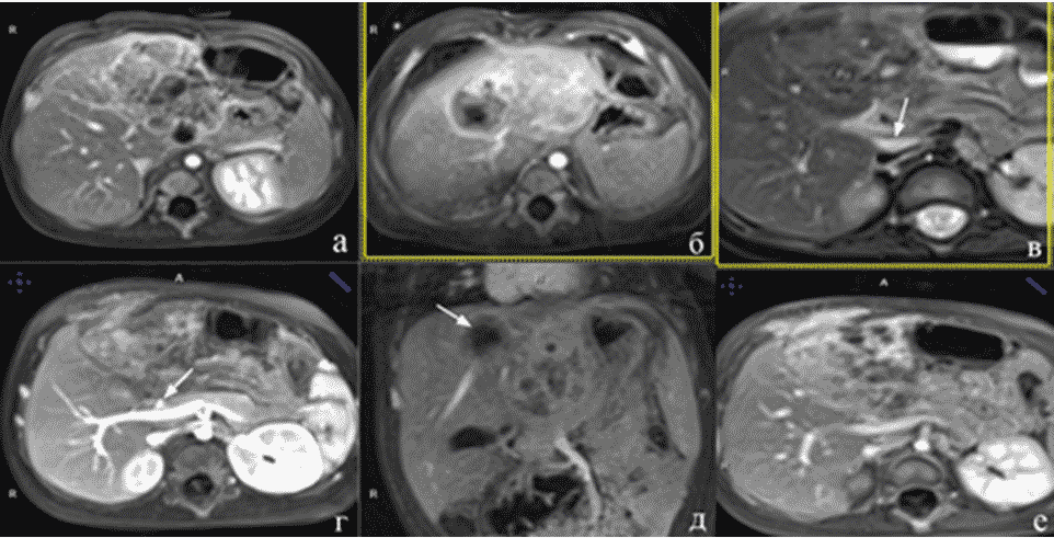 Контраст печени. Гепатобластома у детей кт. Гепатобластома гистогенез. Очаги в печени на кт с контрастированием.