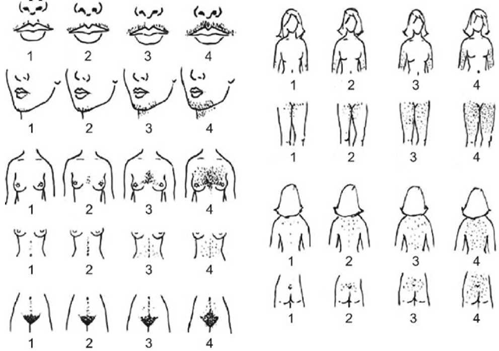 Разновидности женских органов и размеры в картинках. Гирсутизм шкала Ферримана. Шкала Ферримана Голвея. Ферримана Голлвея.