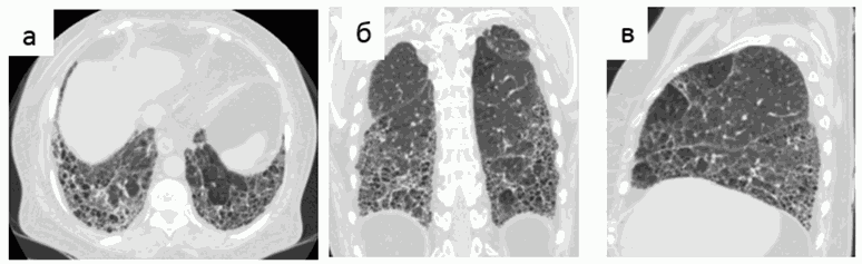 Идиопатический легочный фиброз клинические рекомендации